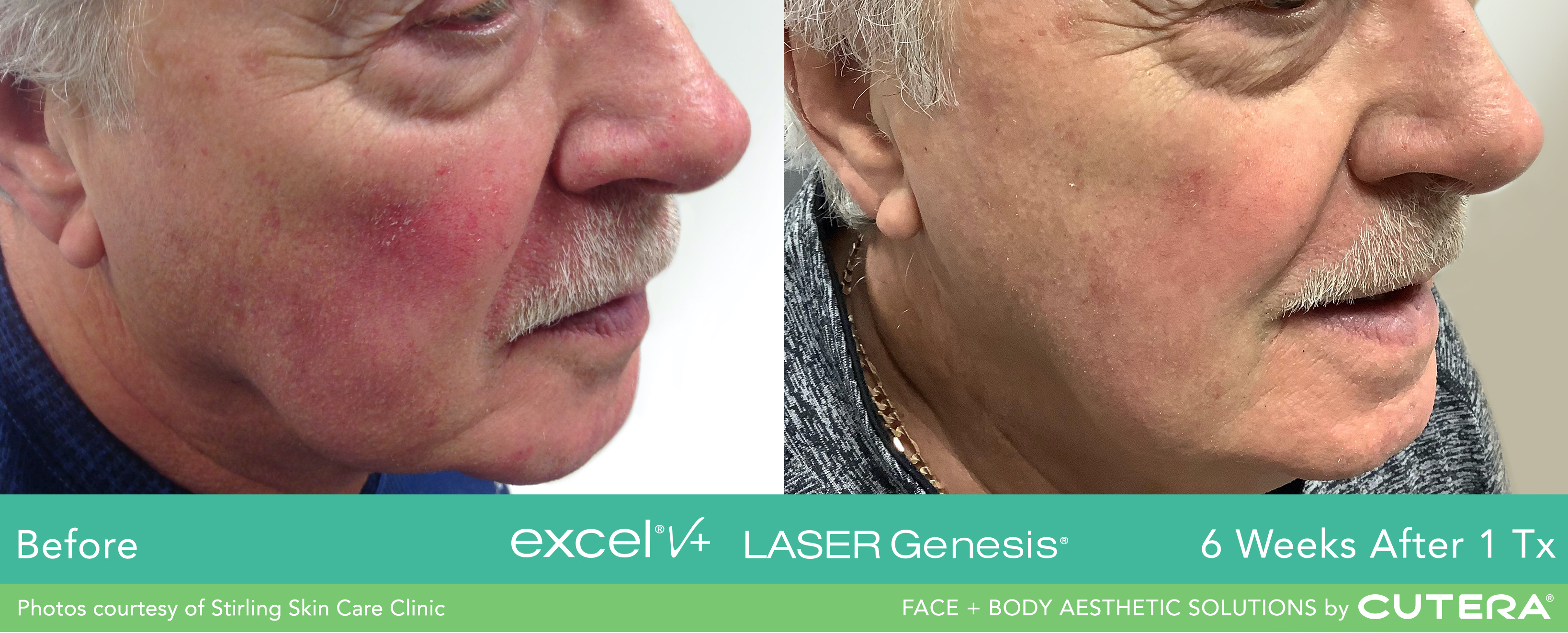 Laser Treatment